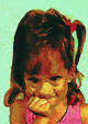 Wonderfully disfigured little girl